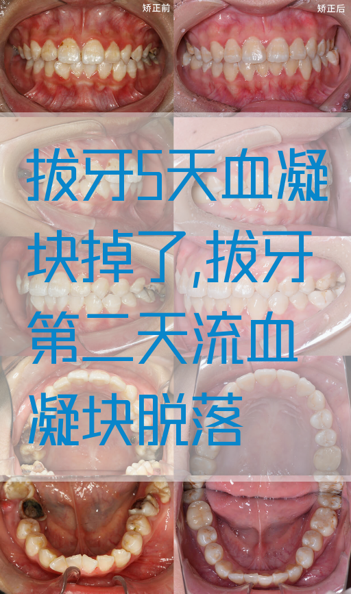 拔牙5天血凝块掉了,拔牙第二天流血凝块脱落