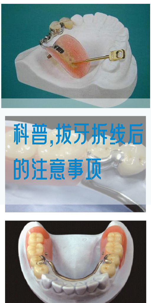 科普,拔牙拆线后的注意事项