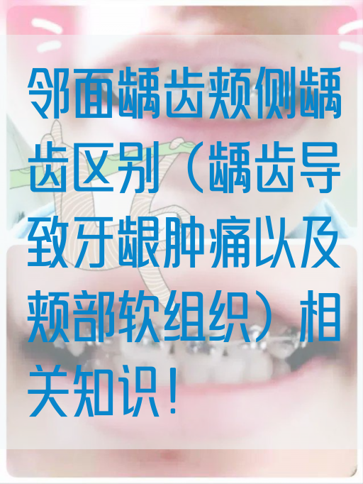 邻面龋齿颊侧龋齿区别（龋齿导致牙龈肿痛以及颊部软组织）相关知识！