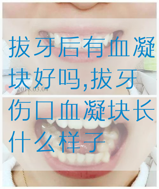 拔牙后有血凝块好吗,拔牙伤口血凝块长什么样子
