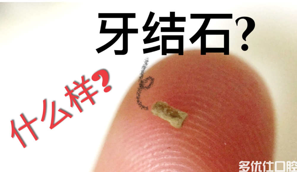 一个牙医的良心忠告，牙结石不去除会越来越严重