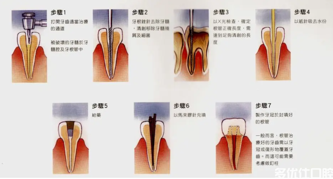 牙烂到什么程度要根管治疗?