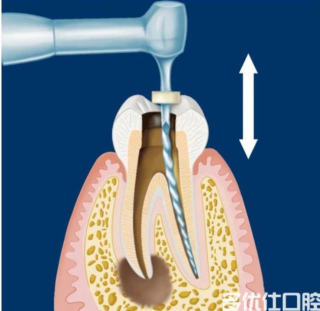 牙烂到什么程度要根管治疗?