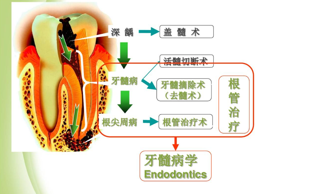 牙烂到什么程度要根管治疗?