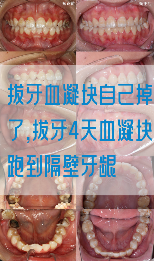 拔牙血凝块自己掉了,拔牙4天血凝块跑到隔壁牙龈