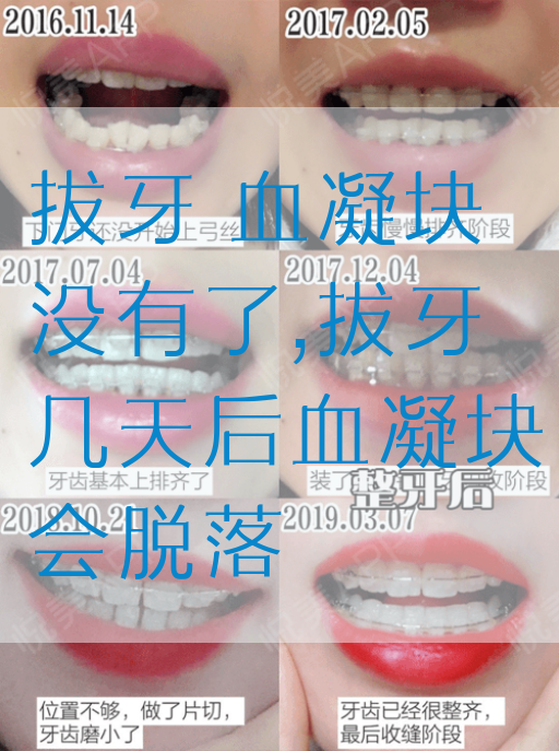 拔牙 血凝块没有了,拔牙几天后血凝块会脱落