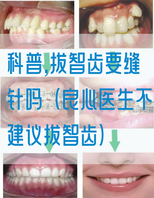 科普,拔智齿要缝针吗（良心医生不建议拔智齿）
