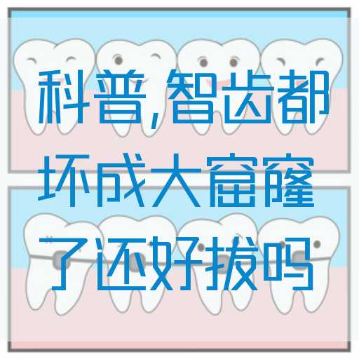 科普,智齿都坏成大窟窿了还好拔吗