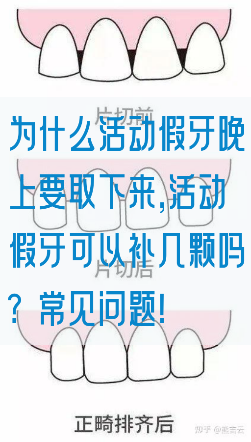 为什么活动假牙晚上要取下来,活动假牙可以补几颗吗？常见问题！