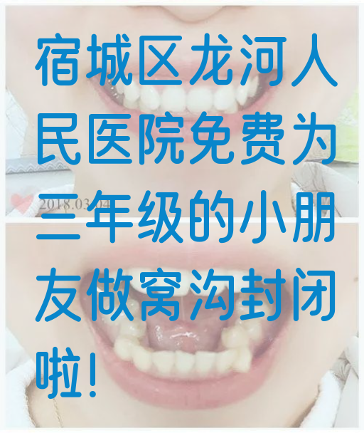 宿城区龙河人民医院免费为三年级的小朋友做窝沟封闭啦！