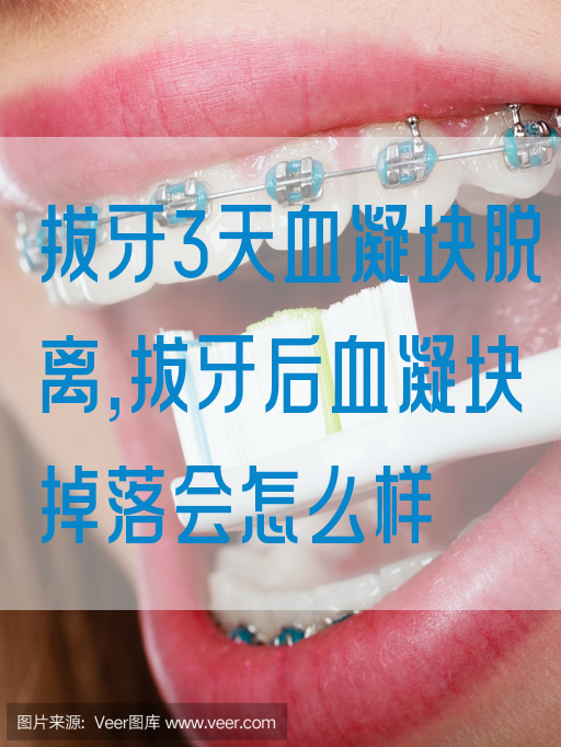拔牙3天血凝块脱离,拔牙后血凝块掉落会怎么样