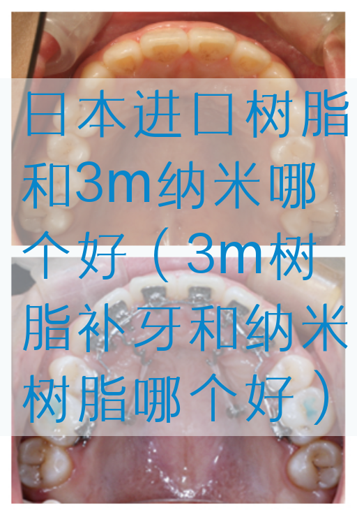 日本进口树脂和3m纳米哪个好（3m树脂补牙和纳米树脂哪个好）(图1)