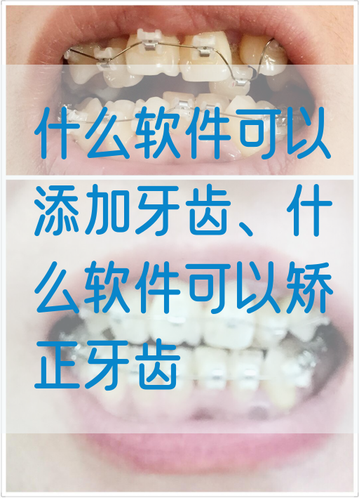 什么软件可以添加牙齿、什么软件可以矫正牙齿(图1)