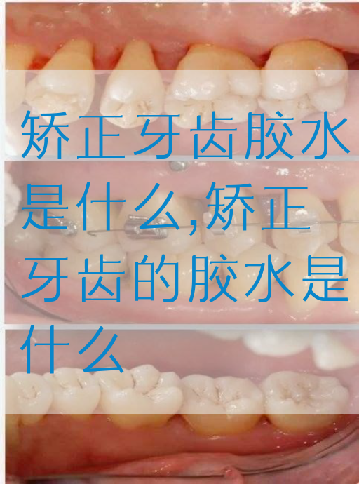 矫正牙齿胶水是什么,矫正牙齿的胶水是什么(图1)