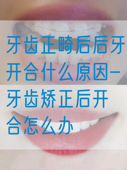 牙齿正畸后后牙开合什么原因-牙齿矫正后开合怎么办