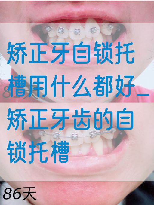 矫正牙自锁托槽用什么都好_矫正牙齿的自锁托槽