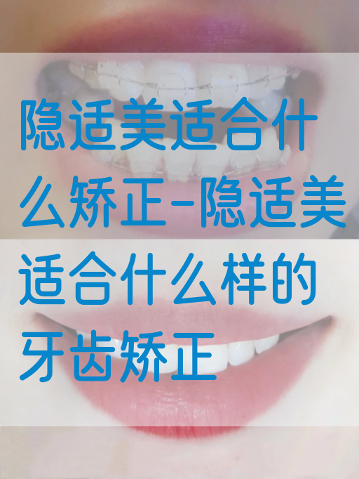 隐适美适合什么矫正-隐适美适合什么样的牙齿矫正