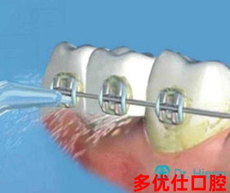 超声波振动洗牙区别-声波洗牙和超声波洗牙的区别：超声波振动：让洗牙更彻底