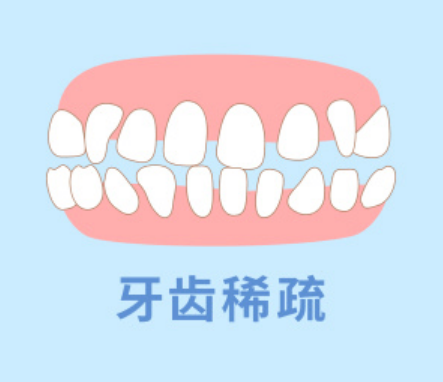 牙齿稀疏
