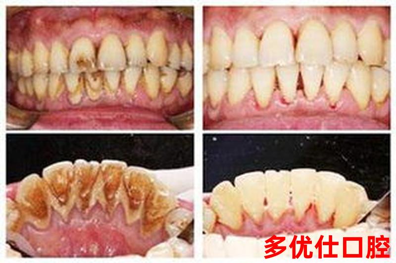 洗牙后舔牙牙齿会松动吗、洗完牙舔牙