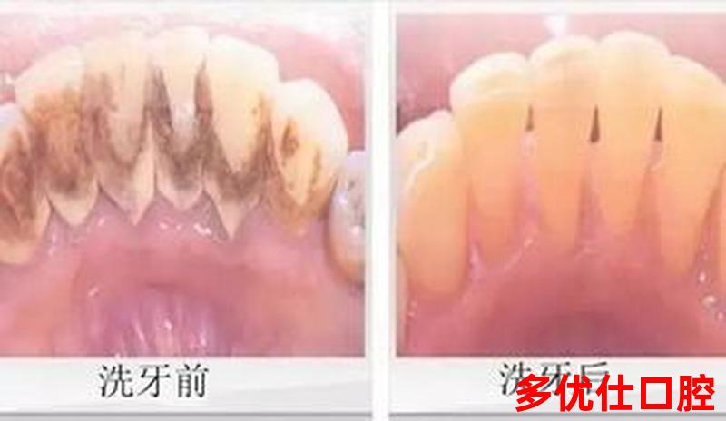 洗牙后舔牙牙齿会松动吗、洗完牙舔牙