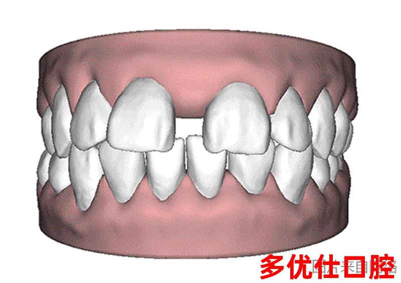 牙齿二级松动能做固牙术吗,2级松动的牙齿还能保存多长时间