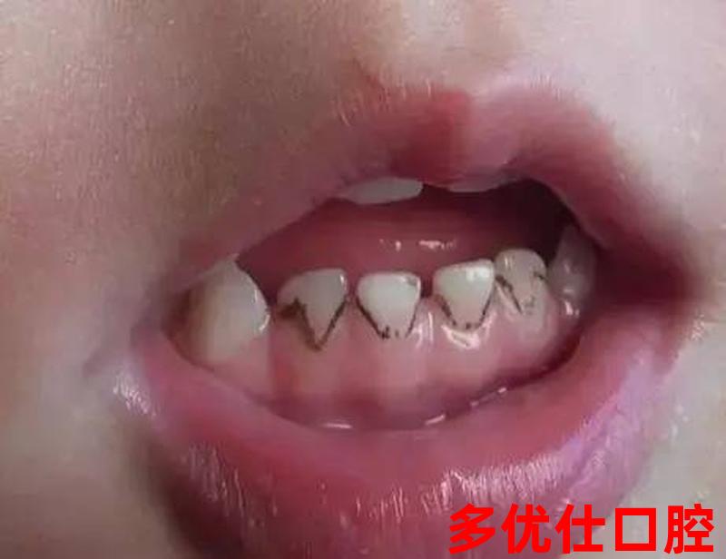 牙齿发黑松动牙会脱落吗(牙齿发黑松动牙会脱落吗怎么治疗)