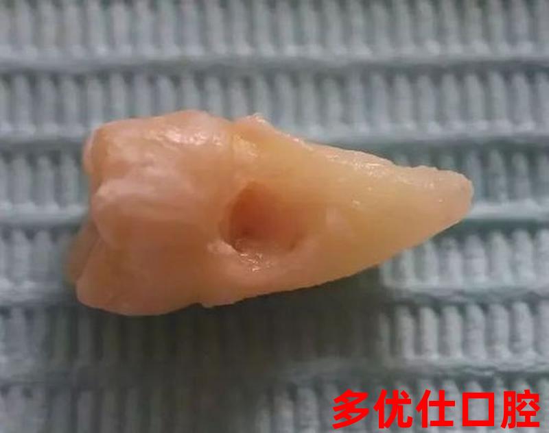牙齿坏了洞口臭吗(牙坏了个洞特别臭)