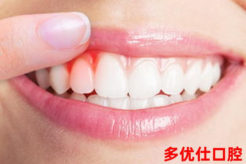 牙齿烂了牙龈炎多久自愈、牙龈发炎烂掉