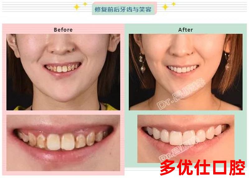 牙齿黄牙龈出血怎么办_牙发黄出血
