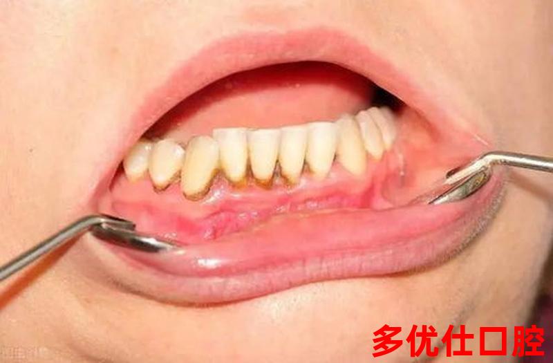 牙齿黄口臭身体不好怎么办-牙齿发黄有口臭怎么能治疗