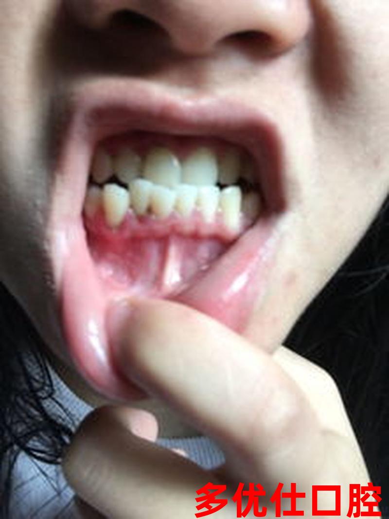 牙龈一出血牙齿就疼怎么办(牙龈一嗯就出血)