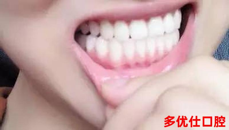 矫正牙齿警惕牙龈炎吗;牙齿矫正牙龈有变化吗