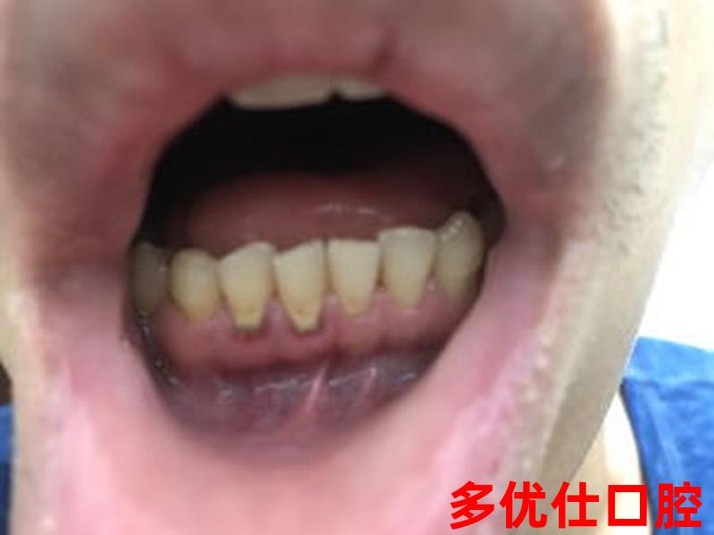 矫正牙齿牙龈不出血怎么办_牙齿矫正牙龈出血是什么原因