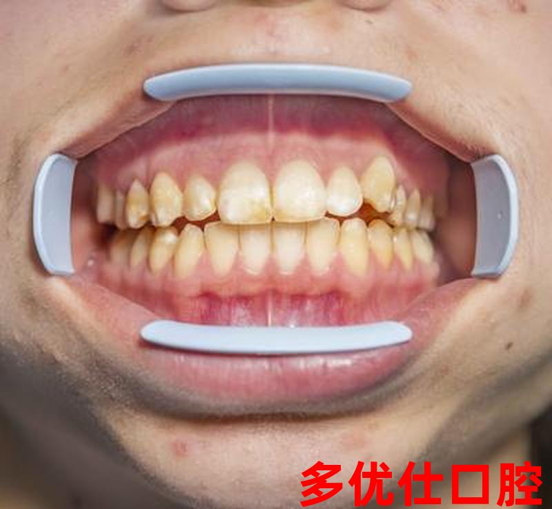 去牙渍烟渍的方法,烟渍牙*吗？