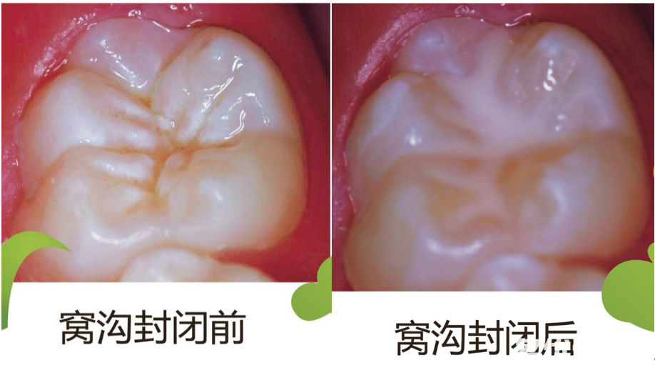 窝沟封闭前后对比图