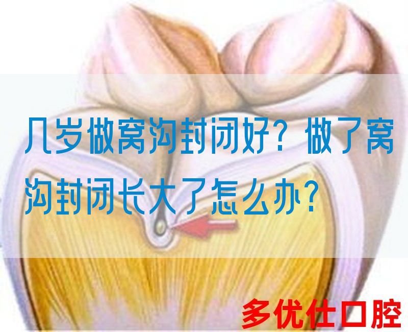 几岁做窝沟封闭好?做了窝沟封闭长大了怎么办?(图1)