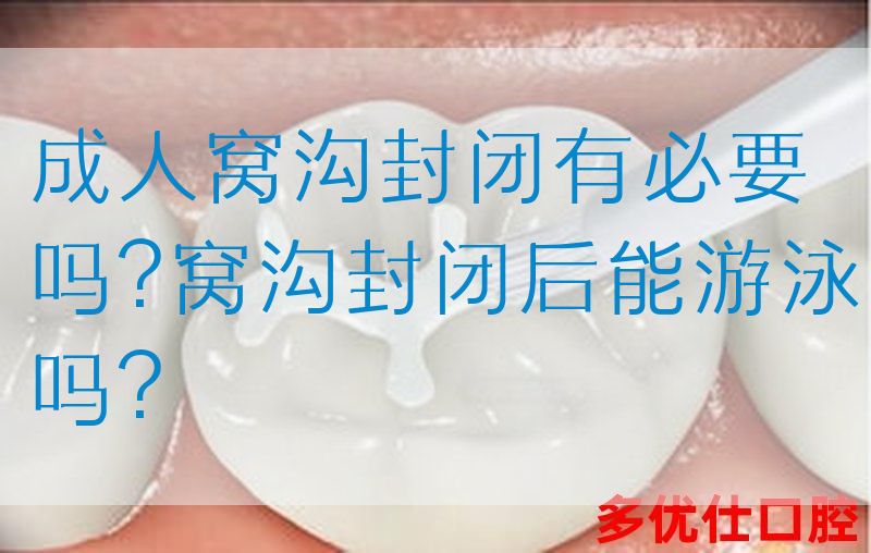 成人窝沟封闭有必要吗?窝沟封闭后能游泳吗?(图1)