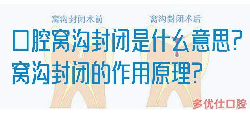 口腔窝沟封闭是什么意思?窝沟封闭的作用原理?
