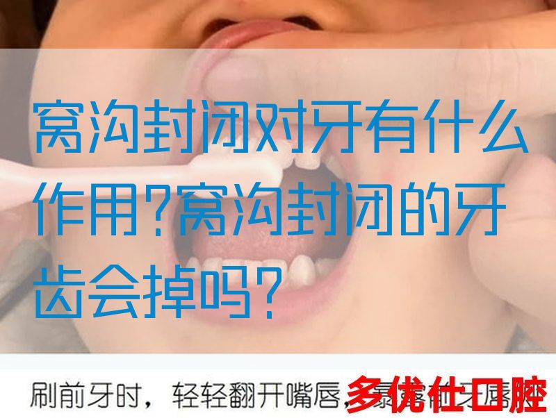 窝沟封闭对牙有什么作用?窝沟封闭的牙齿会掉吗?