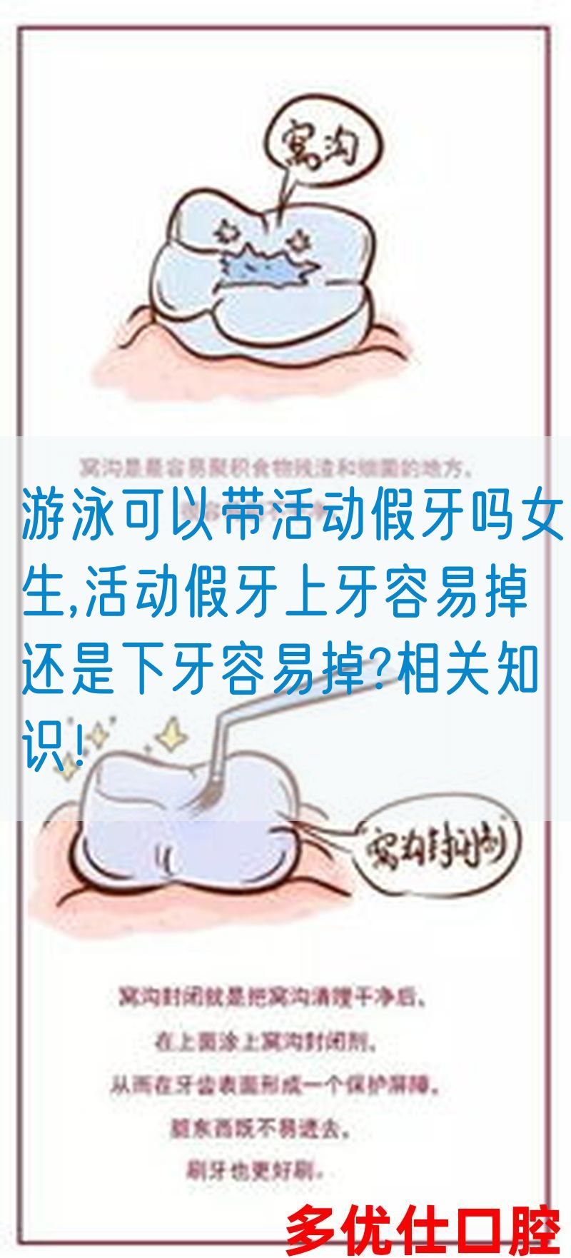 游泳可以带活动假牙吗女生,活动假牙上牙容易掉还是下牙容易掉?相关知识！(图1)