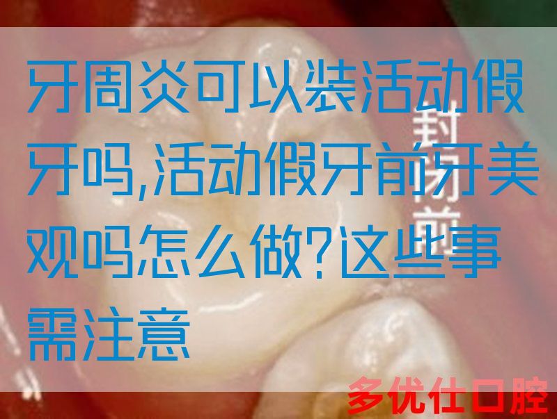 牙周炎可以装活动假牙吗,活动假牙前牙美观吗怎么做?这些事需注意