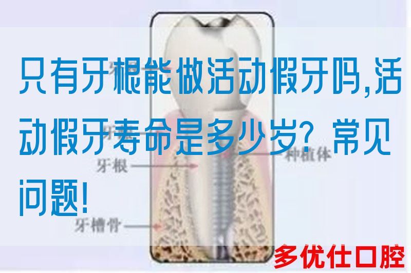 只有牙根能做活动假牙吗,活动假牙寿命是多少岁？常见问题！(图1)