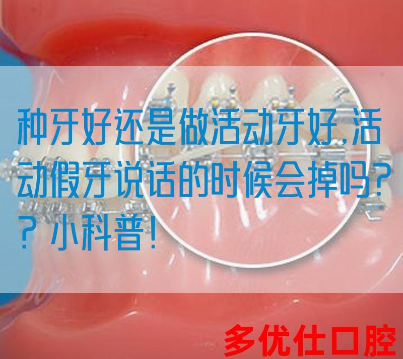 种牙好还是做活动牙好,活动假牙说话的时候会掉吗？？小科普！(图1)