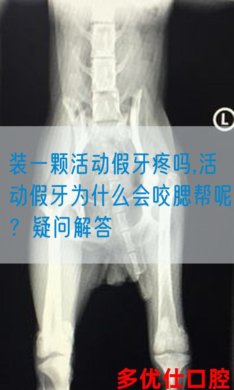 装一颗活动假牙疼吗,活动假牙为什么会咬腮帮呢？疑问解答(图1)
