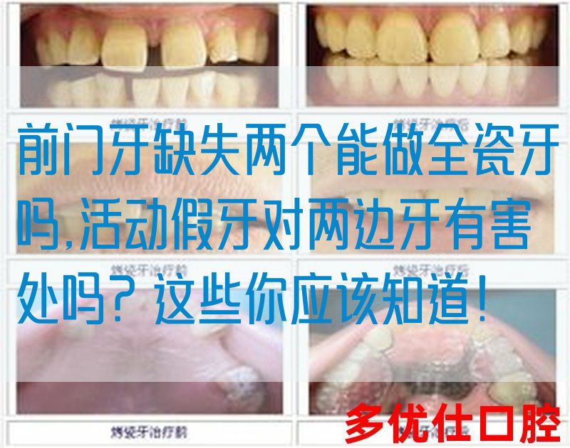 前门牙缺失两个能做全瓷牙吗,活动假牙对两边牙有害处吗？这些你应该知道！(图1)