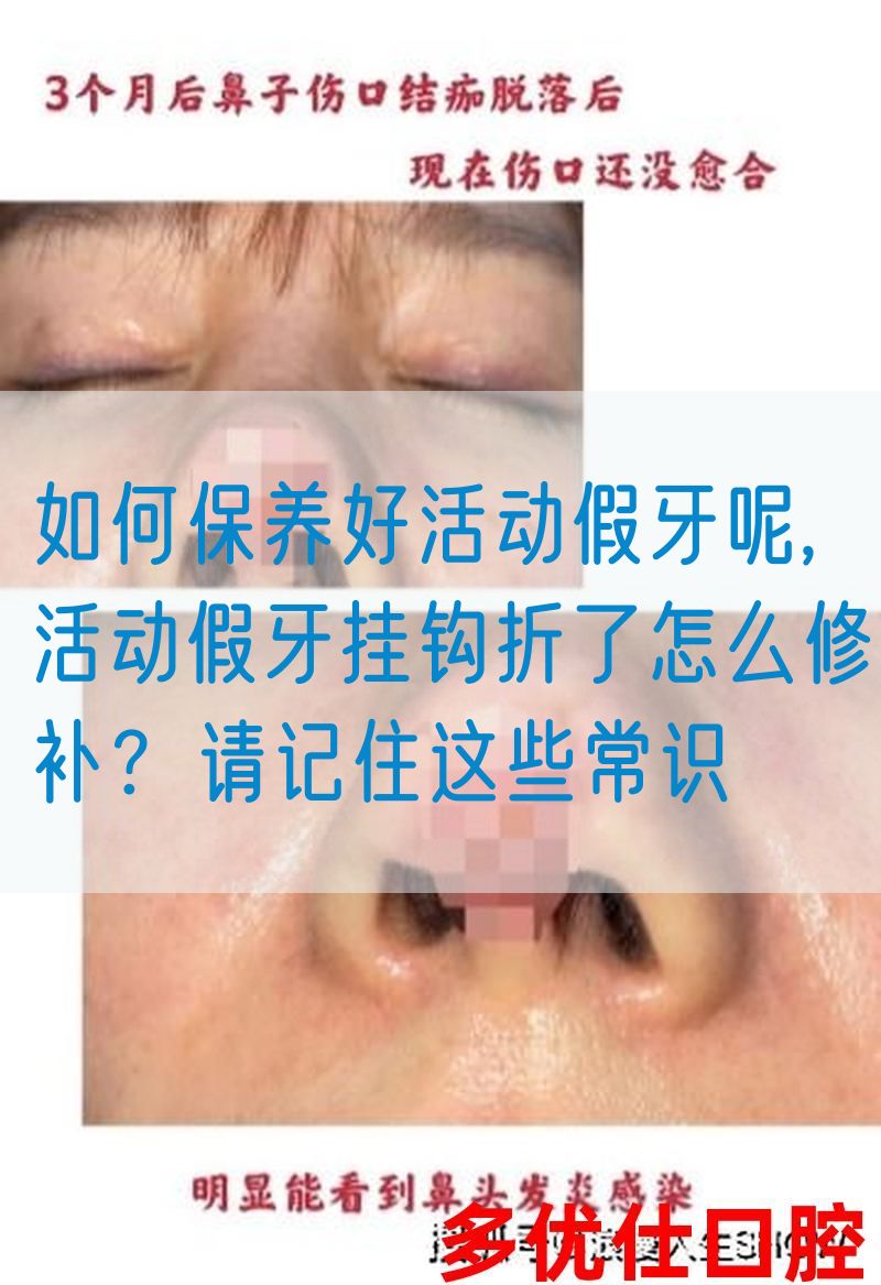如何保养好活动假牙呢,活动假牙挂钩折了怎么修补？请记住这些常识(图1)