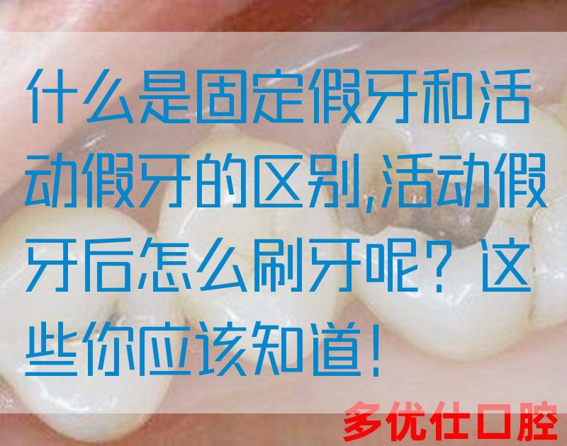 什么是固定假牙和活动假牙的区别,活动假牙后怎么刷牙呢？这些你应该知道！(图1)
