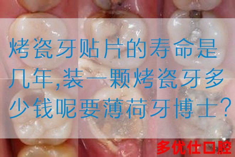 烤瓷牙贴片的寿命是几年,装一颗烤瓷牙多少钱呢要薄荷牙博士？(图1)
