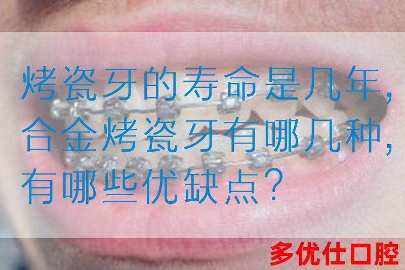 烤瓷牙的寿命是几年,合金烤瓷牙有哪几种,有哪些优缺点？(图1)